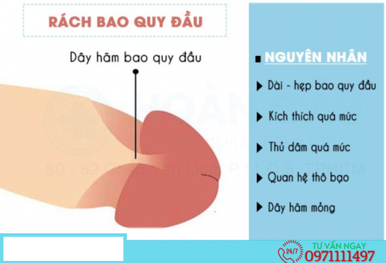 rách bao quy đầu.png