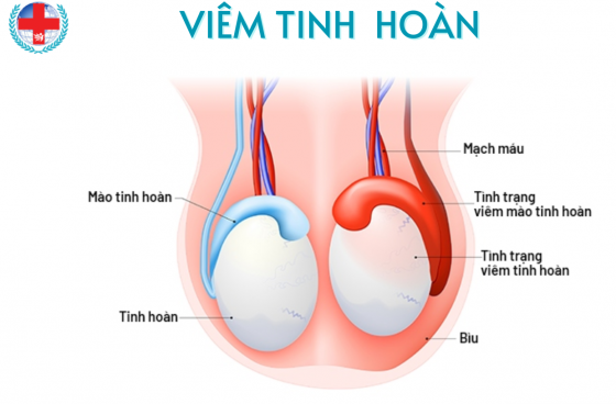 VIÊM TINH HÀON.png