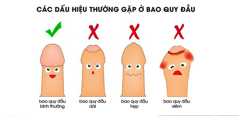 Hẹp bao quy đầu có gây ảnh hưởng lớn đến sức khỏe không?