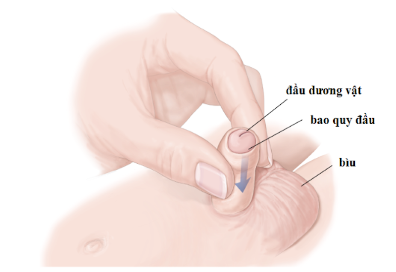 Dính bao quy đầu ở trẻ em do đâu và cách điều trị?
