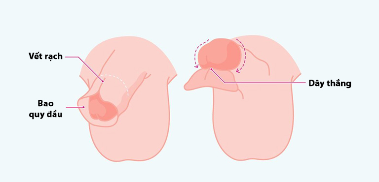 Cách Chăm Sóc Sau Khi Cắt Bao Quy Đầu Giúp Nhanh Hồi Phục & Lưu Ý