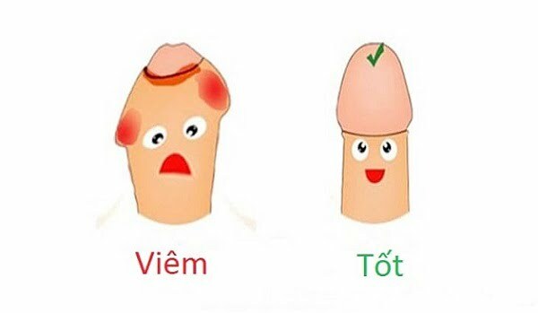 Viêm bao quy đầu: Nguyên nhân và cách phòng ngừa