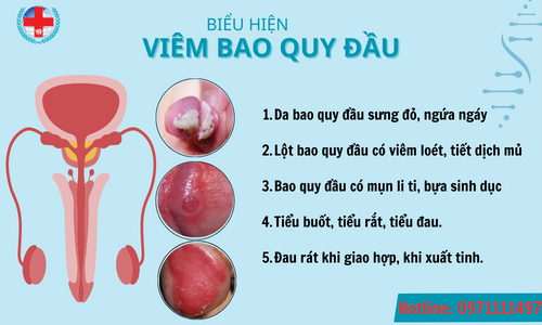 BIỂU HIỆN VIÊM BAO QUY ĐẦU.png