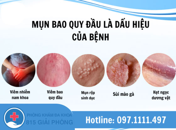 MỤN BAO QUY ĐẦU.jpg
