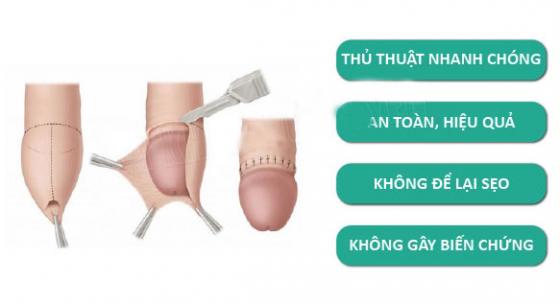 CÁCH CHỮA BỆNH HẸP BAO QUY ĐẦU