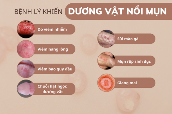 duong-vat-noi-mun-la-do-dau-va-dieu-tri-ra-sao-4.png
